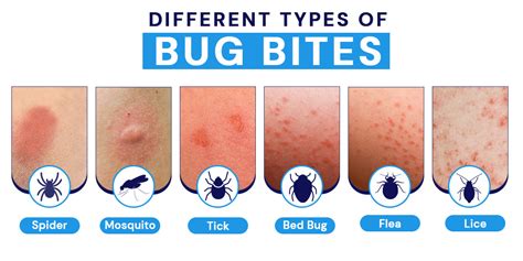 massage bites|How to treat a bug bite at home (and when to head to the ER).